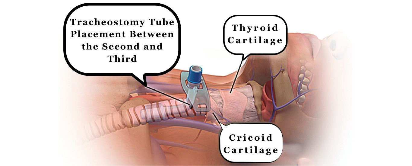 Tracheostomy Tube Change at Home | Expert Nursing Care – CareOxy