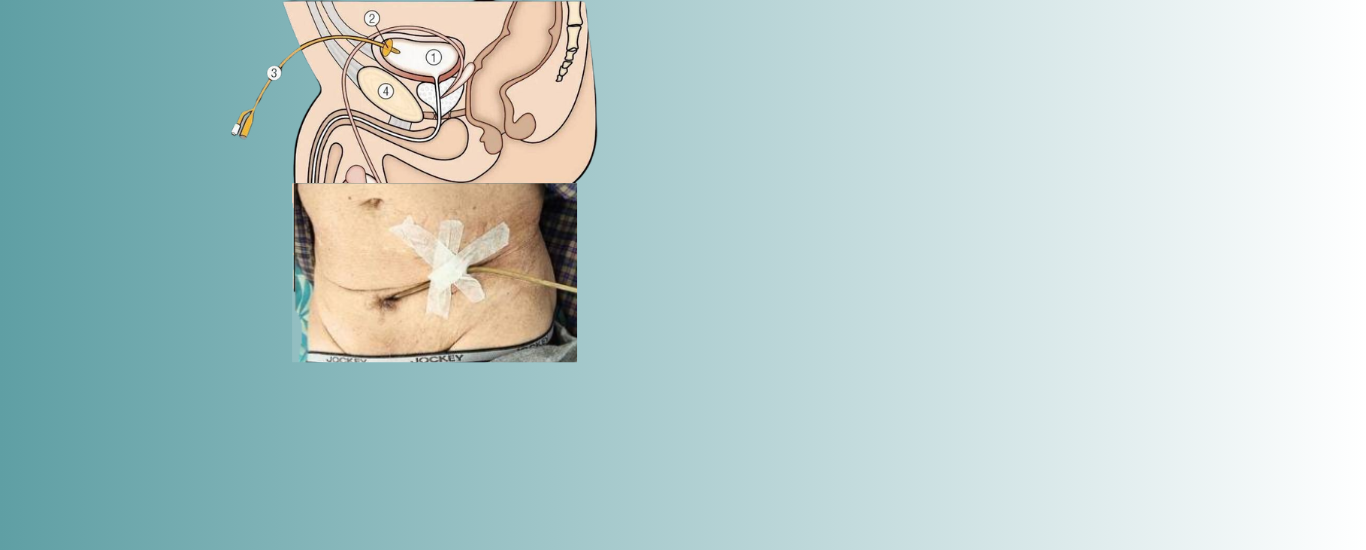 Suprapubic Catheterization Service At Home