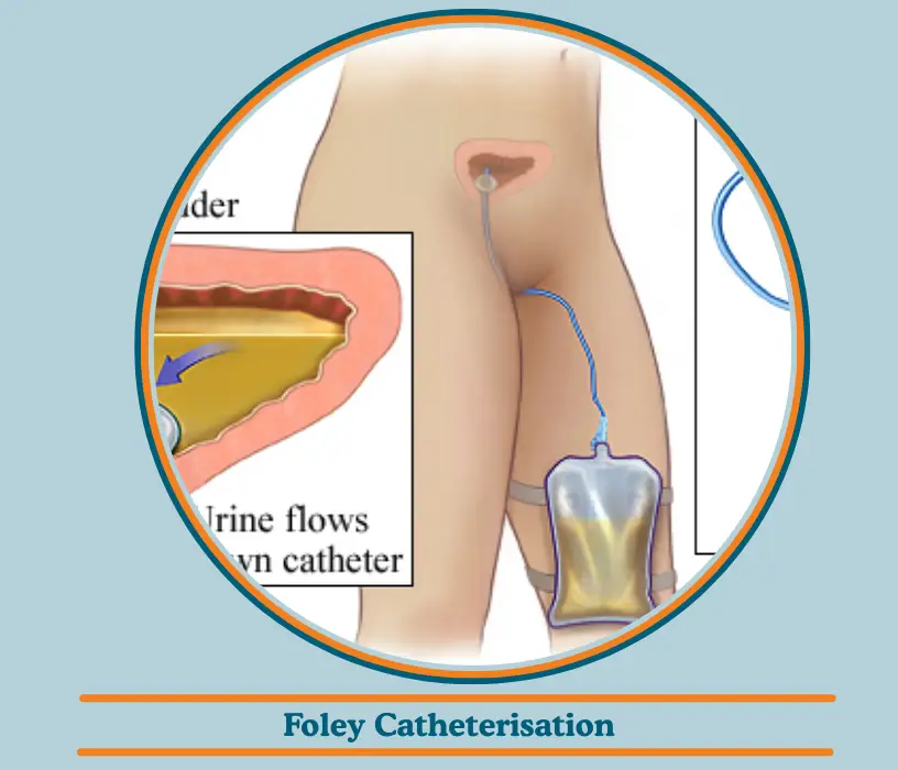 Foley Catheterisation
