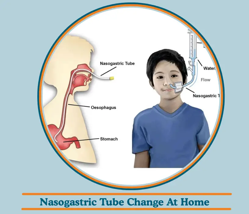Nasogastric Tube Change At Home